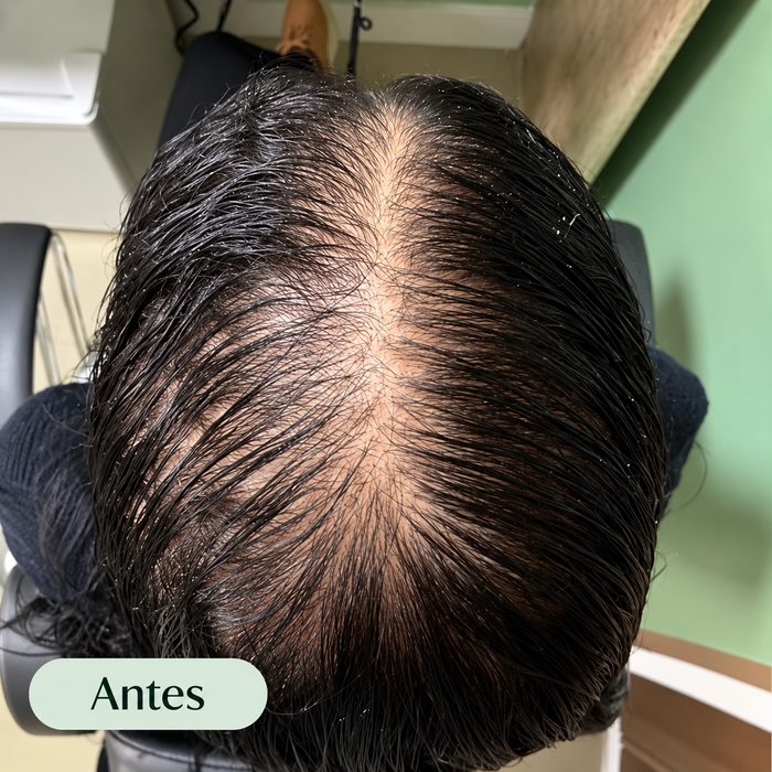 Antes